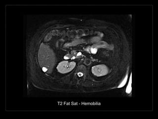 T2 Fat Sat - Hemobilia
 