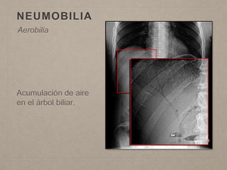 NEUMOBILIA
Acumulación de aire
en el árbol biliar.
Aerobilia
 
