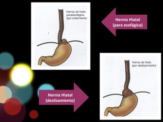 Hernia Hiatal
(para esofágica)
Hernia Hiatal
(deslizamiento)
 