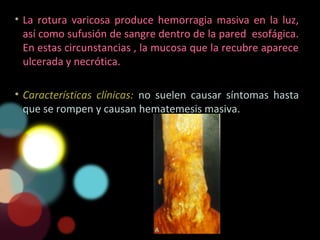 • La rotura varicosa produce hemorragia masiva en la luz,
así como sufusión de sangre dentro de la pared esofágica.
En estas circunstancias , la mucosa que la recubre aparece
ulcerada y necrótica.
• Características clínicas: no suelen causar síntomas hasta
que se rompen y causan hematemesis masiva.
 