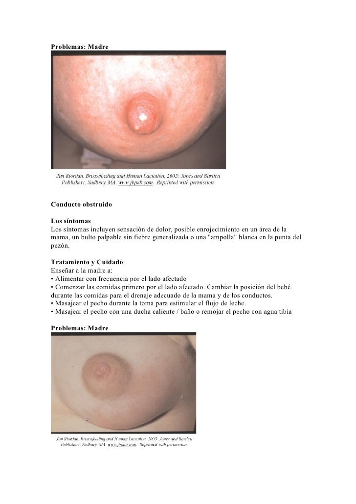 Las posibilidades después de la operación el cáncer de mama
