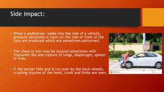 Side impact:
• When a pedestrian walks into the side of a vehicle,
pressure abrasions or tears on the side or front of the
face are produced which are sometimes patterned.
• The chest or loin may be injured sometimes with
fractured ribs and rupture of lungs, diaphragm, spleen
or liver.
• If the person falls and is run over by the back wheels,
crushing injuries of the head, trunk and limbs are seen.
 