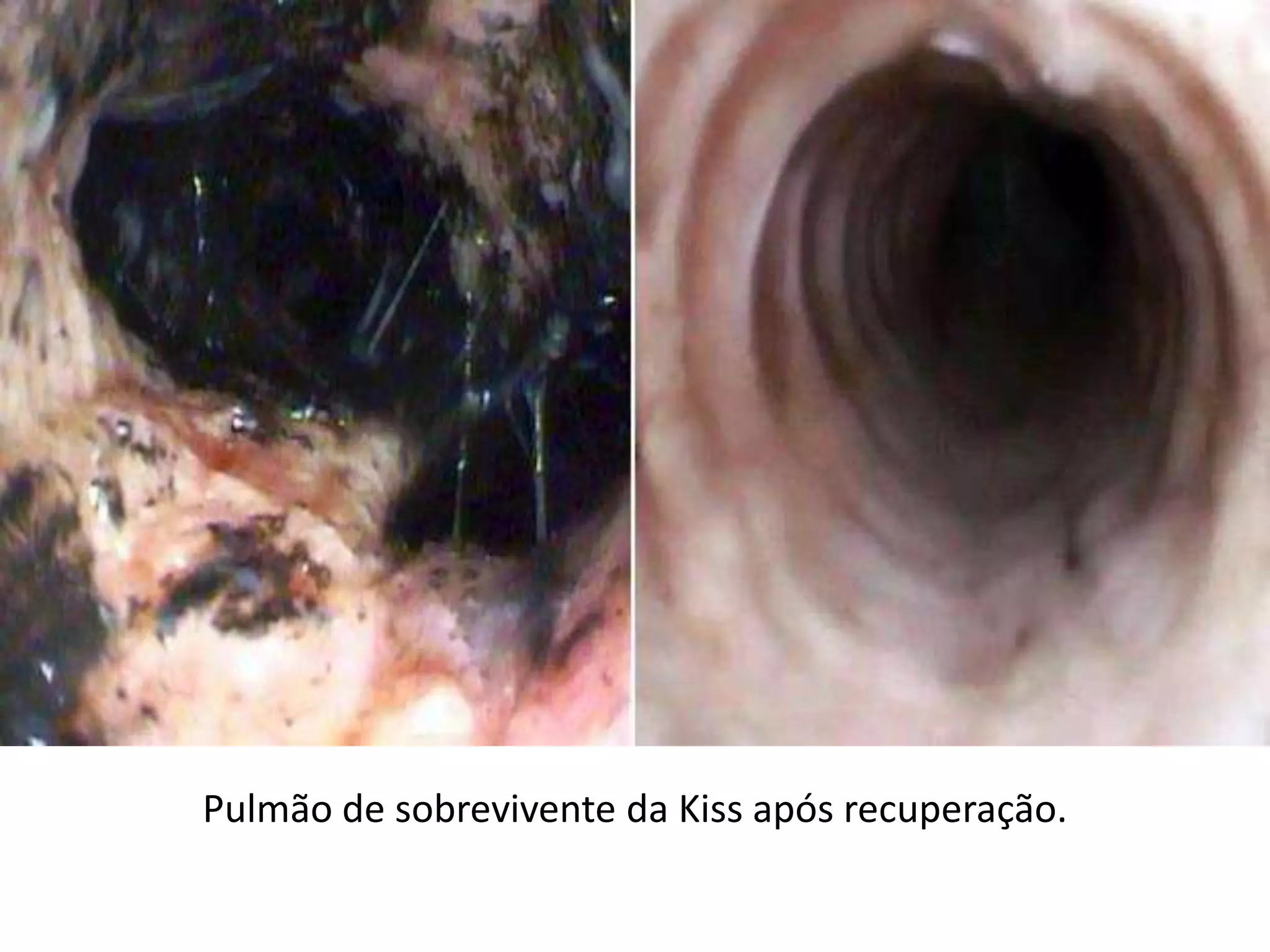 Pulmão de sobrevivente da Kiss após recuperação.