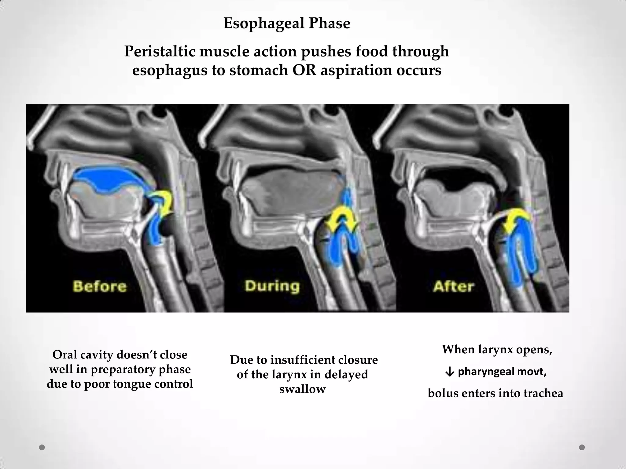 Esophageal Phase
             Peristaltic muscle action pushes food through
              esophagus to stomach OR aspiration occurs




 Oral cavity doesn’t close                                   When larynx opens,
                             Due to insufficient closure
well in preparatory phase     of the larynx in delayed        ↓ pharyngeal movt,
due to poor tongue control             swallow             bolus enters into trachea
 