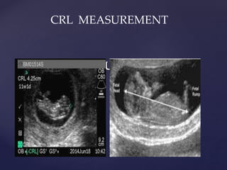 HOW TO MEASURE USING CRL
CRL MEASUREMENT
 