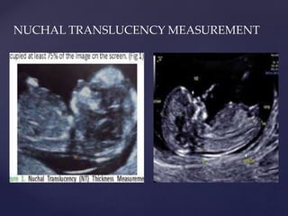 {
NUCHAL TRANSLUCENCY MEASUREMENT
 