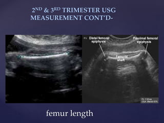 {
2ND & 3RD TRIMESTER USG
MEASUREMENT CONT’D-
femur length
 
