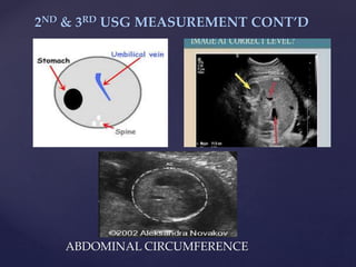 {
2ND & 3RD USG MEASUREMENT CONT’D
ABDOMINAL CIRCUMFERENCE
 