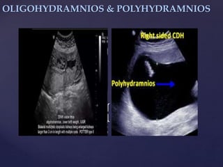 {
OLIGOHYDRAMNIOS & POLYHYDRAMNIOS
 