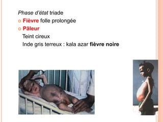 Phase d’état triade
 Fièvre folle prolongée
 Pâleur
Teint cireux
Inde gris terreux : kala azar fièvre noire
 