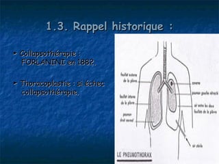 1.3. Rappel historique :

► Collapsothérapie :
  FORLANINI en 1882.

► Thoracoplastie : si échec
  collapsothérapie.
 