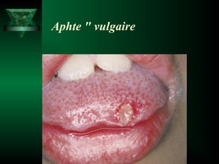 Aphte " vulgaire

 