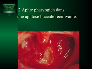 2 Aphte pharyngien dans
une aphtose buccale récidivante.

 