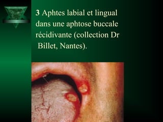 3 Aphtes labial et lingual
dans une aphtose buccale
récidivante (collection Dr
Billet, Nantes).

 