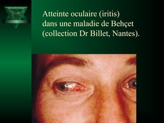 Atteinte oculaire (iritis)
dans une maladie de Behçet
(collection Dr Billet, Nantes).

 