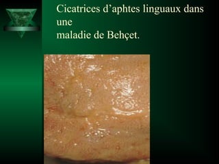 Cicatrices d’aphtes linguaux dans
une
maladie de Behçet.

 
