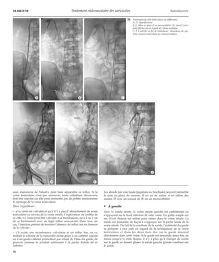 34-450-D-10 Traitement endovasculaire des varicocèles Radiodiagnostic 
*A *B *C 
sous manoeuvre de Valsalva peut faire apparaître ce reflux. Si la 
veine testiculaire n’est pas retrouvée, toute collatérale découverte 
doit être injectée car elle peut permettre par de petites anastomoses 
le repérage de la veine testiculaire. 
Deux hypothèses : 
– si la veine est valvulée et qu’il n’y a pas d’ abouchement de veine 
testiculaire au niveau de la veine rénale, l’exploration est arrêtée de 
ce côté. La veine peut être valvulée à sa terminaison, ou à 2 ou 3 cm 
de sa terminaison avec un léger reflux sous-jacent. Dans tous ces 
cas, l’injection permet de montrer l’absence de reflux net en dessous 
de la valvule ; 
– s’il existe une incontinence valvulaire et un reflux bas, on va 
réaliser la sclérose de la varicocèle droite grâce à un cathéter coaxial 
ou à un guide-cathéter permettant par retrait de l’âme du guide, de 
pouvoir pousser le produit sclérosant à la partie distale de ce 
cathéter. 
16 Traitement du côté droit (deux cas différents). 
A, D. Opacification. 
B, E. Mise en place d’un microcathéter (1), dont l’extré-mité 
(flèche) est en regard de l’épine sciatique. 
C, F. Contrôle en fin de traitement : thrombose du sys-tème 
veineux testiculaire au niveau lombaire. 
Les abords par voie haute (jugulaire ou brachiale) peuvent permettre 
la mise en place de ressorts. Il en est de même si on utilise des 
sondes 5F avec un coaxial de 3F ou un microcathéter. 
¦ À gauche 
Avec la sonde droite, la veine rénale gauche est cathétérisée en 
s’appuyant sur le bord inférieur de cette veine. Un guide souple sur 
ses 10 cm distaux est utilisé pour entrer dans la veine rénale. La 
sonde est remontée, de façon à s’appuyer sur la partie haute de la 
veine rénale. Du fait de la courbure de la sonde, l’extrémité du guide 
se présente à peu près en regard de la terminaison de la veine 
testiculaire et dans les deux tiers des cas le guide descend 
directement dans cette veine. Si le guide est descendu assez bas, au 
moins jusqu’à la crête iliaque, il n’y a plus qu’à changer de sonde 
sur le guide en faisant glisser la sonde gauche grande courbure sur 
le guide. 
*D *E 
*F 
10 
 