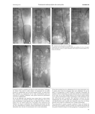Radiodiagnostic Traitement endovasculaire des varicocèles 34-450-D-10 
*A *B *C *D 
Lorsque le guide ne pénètre pas dans la veine testiculaire, l’échange 
de sonde a lieu dans la veine rénale : le maniement de la sonde 
permet le cathétérisme qui n’est pas toujours facile ; la sonde peut 
être redressée en s’appuyant sur la veine surrénalienne pour lui 
redonner la courbure adéquate, cette petite manoeuvre permettant 
souvent le cathétérisme. 
En cas de difficulté, une injection sous scopie dans la veine rénale 
sous manoeuvre de Valsalva décèle la veine testiculaire. En cas de 
non-visualisation, il faut injecter avec un débit de 8-9 mL/s (30 mL 
total) avec un cliché toutes les 2 secondes sous manoeuvre de 
Valsalva, de façon à rechercher des collatérales provenant du hile 
du rein, réopacifiant le système veineux testiculaire sous-jacent et à 
démontrer une valvule à la terminaison de la veine testiculaire. 
17 Traitement du côté gauche (3 cas différents). 
Cathétérisme aisé de la veine testiculaire unique sans problème. En (A, C, E) aspect 
avant traitement, en (B, D, F) après traitement, mise en place de ressorts (flèche) et in-jection 
de sclérosant. 
Il faut être prudent lors du cathétérisme de la veine testiculaire avec 
le guide, pour éviter de s’engager dans une collatérale. En cas de 
gêne à la progression, il faut s’arrêter et opacifier l’ensemble du 
système veineux testiculaire, la sonde étant proche de la terminaison 
de la veine, un ou deux clichés hauts et un ou deux clichés centrés 
sur le pelvis fournissant le bilan anatomique. Cette technique évite 
des effractions par le guide, des spasmes veineux ou des 
engagements de la sonde dans des collatérales. Ce n’est qu’après 
ces opacifications que le guide sera descendu assez bas au niveau 
pelvien sous scopie en comparant avec l’image anatomique. 
Pour descendre la sonde à grande courbure, il faut, en faisant un 
point fixe avec le guide, secouer la sonde sur le guide très proche de 
son point d’entrée de façon à la faire progresser. La progression n’est 
*E *F 
11 
 