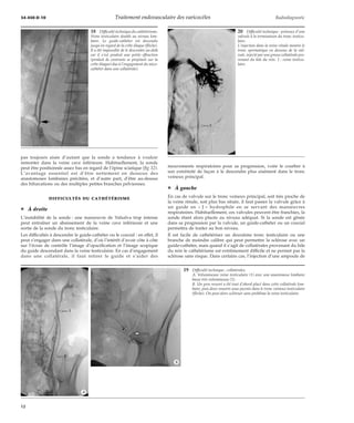 34-450-D-10 Traitement endovasculaire des varicocèles Radiodiagnostic 
pas toujours aisée d’autant que la sonde a tendance à vouloir 
remonter dans la veine cave inférieure. Habituellement, la sonde 
peut être positionnée assez bas en regard de l’épine sciatique (fig 32). 
L’avantage essentiel est d’être nettement en dessous des 
anastomoses lombaires précitées, et d’autre part, d’être au-dessus 
des bifurcations ou des multiples petites branches pelviennes. 
DIFFICULTÉS DU CATHÉTÉRISME 
¦ À droite 
L’instabilité de la sonde : une manoeuvre de Valsalva trop intense 
peut entraîner un abaissement de la veine cave inférieure et une 
sortie de la sonde du tronc testiculaire. 
Les difficultés à descendre le guide-cathéter ou le coaxial : en effet, il 
peut s’engager dans une collatérale, d’où l’intérêt d’avoir côte à côte 
sur l’écran de contrôle l’image d’opacification et l’image scopique 
du guide descendant dans la veine testiculaire. En cas d’engagement 
dans une collatérale, il faut retirer le guide et s’aider des 
mouvements respiratoires pour sa progression, voire le courber à 
son extrémité de façon à le descendre plus aisément dans le tronc 
veineux principal. 
¦ À gauche 
En cas de valvule sur le tronc veineux principal, soit très proche de 
la veine rénale, soit plus bas située, il faut passer la valvule grâce à 
un guide en « J » hydrophile en se servant des manoeuvres 
respiratoires. Habituellement, ces valvules peuvent être franchies, la 
sonde étant alors placée au niveau adéquat. Si la sonde est gênée 
dans sa progression par la valvule, un guide-cathéter ou un coaxial 
permettra de traiter au bon niveau. 
Il est facile de cathétériser un deuxième tronc testiculaire ou une 
branche de moindre calibre qui peut permettre la sclérose avec un 
guide-cathéter, mais quand il s’agit de collatérales provenant du hile 
du rein le cathétérisme est extrêmement difficile et ne permet pas la 
sclérose sans risque. Dans certains cas, l’injection d’une ampoule de 
18 Difficulté technique du cathétérisme. 
Veine testiculaire double au niveau lom-baire. 
Le guide-cathéter est descendu 
jusqu’en regard de la crête iliaque (flèche). 
Il a été impossible de le descendre au-delà 
car il s’est produit une petite effraction 
(produit de contraste se projetant sur la 
crête iliaque) due à l’engagement du mico-cathéter 
dans une collatérale). 
19 Difficulté technique : collatérales. 
A. Volumineuse veine testiculaire (1) avec une anastomose lombaire 
basse très volumineuse (2). 
B. Un gros ressort a été tout d’abord placé dans cette collatérale lom-baire, 
puis deux ressorts sous-jacents dans le tronc veineux testiculaire 
(flèche). On peut alors scléroser sans problème la veine testiculaire. 
*A 
*B 
20 Difficulté technique : présence d’une 
valvule à la terminaison du tronc testicu-laire. 
L’injection dans la veine rénale montre le 
tronc spermatique en dessous de la val-vule, 
injecté par une grosse collatérale pro-venant 
du hile du rein. 1 : veine testicu-laire. 
12 
 