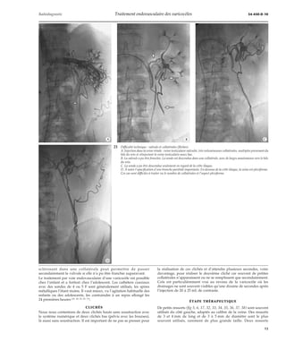 Radiodiagnostic Traitement endovasculaire des varicocèles 34-450-D-10 
*A *B *C 
21 Difficulté technique : valvule et collatérales (flèches). 
A. Injection dans la veine rénale : veine testiculaire valvulée, très volumineuses collatérales, multiples provenant du 
hile du rein et réinjectant la veine testiculaire assez bas. 
B. La valvule a pu être franchie. La sonde est descendue dans une collatérale, avec de larges anastomoses vers le hile 
du rein. 
C. La sonde a pu être descendue seulement en regard de la crête iliaque. 
D. À noter l’opacification d’une branche pariétale importante. En dessous de la crête iliaque, la veine est plexiforme. 
Ces cas sont difficiles à traiter vu le nombre de collatérales et l’aspect plexiforme. 
sclérosant dans une collatérale peut permettre de passer 
secondairement la valvule si elle n’a pu être franchie auparavant. 
Le traitement par voie endovasculaire d’une varicocèle est possible 
chez l’enfant et a fortiori chez l’adolescent. Les cathéters coaxiaux 
avec des sondes de 4 ou 5 F sont généralement utilisés, les spires 
métalliques l’étant moins. Il vaut mieux, vu l’agitation habituelle des 
enfants ou des adolescents, les contraindre à un repos allongé les 
24 premières heures [27, 28, 29, 65, 71]. 
CLICHÉS 
Nous nous contentons de deux clichés hauts sans soustraction avec 
le système numérique et deux clichés bas (pelvis avec les bourses), 
là aussi sans soustraction. Il est important de ne pas se presser pour 
la réalisation de ces clichés et d’attendre plusieurs secondes, voire 
davantage, pour réaliser le deuxième cliché car souvent de petites 
collatérales n’apparaissent ou ne se remplissent que secondairement. 
Cela est particulièrement vrai au niveau de la varicocèle où les 
drainages ne sont souvent visibles qu’une dizaine de secondes après 
l’injection de 20 à 25 mL de contraste. 
ÉTAPE THÉRAPEUTIQUE 
De petits ressorts (fig 5, 6, 17, 32, 33, 34, 35, 36, 37, 38) sont souvent 
utilisés du côté gauche, adaptés au calibre de la veine. Des ressorts 
de 3 et 4 mm de long et de 3 à 5mm de diamètre sont le plus 
souvent utilisés, rarement de plus grande taille. Deux ressorts 
*D 
13 
 