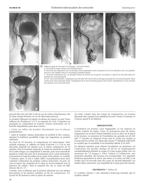 34-450-D-10 Traitement endovasculaire des varicocèles Radiodiagnostic 
*A *B *C 
22 Différents types de varicocèle et de drainage : varicocèles droites. 
"D1 
A. Varicocèle de moyen volume, sans drainage patent. 
B. Varicocèle plus importante avec un drainage veineux pudendal externe se projetant sur le trou obturateur avec une opacifica-tion 
de la veine saphène interne et un drainage prépubien (flèche). 
C. Varicocèle volumineuse avec un drainage veineux de la droite vers la gauche, transeptal, il s’agit d’une varicocèle droite ali-mentant 
peuvent être mis soit côte à côte en cas de veines volumineuses, soit 
un dans chaque branche, en cas de bifurcation précoce. 
Le produit sclérosant est injecté au-dessus du ressort ou seul. Nous 
utilisons du Trombovart à 3 % en ampoule de 2 mL. L’injection est 
pratiquée en comprimant le système veineux testiculaire sur la 
branche iliopubienne pour deux raisons : 
– éviter un reflux du produit directement vers le plexus 
pampiniforme ; 
– isoler le système veineux testiculaire en arrêtant le flux veineux, 
donnant la meilleure possibilité d’agir, par stagnation, au produit 
sclérosant. 
Au bout de 10 minutes, la compression est interrompue. Sans 
contrôle scopique, le cathéter est retiré d’environ 2 à 3 cm et une 
deuxième ampoule est injectée avec la même compression de 10 
minutes. Pour la troisième ampoule, la sonde est remontée en regard 
de la crête iliaque, en comprimant 5 minutes, puis nous remontons 
ensuite la sonde très près de la terminaison de la veine testiculaire. 
Cela permet au trajet lui-même de la sonde d’être obturé. Le contrôle 
5 minutes après se fait à faible débit, manuellement pour bien 
confirmer l’obturation du système veineux testiculaire. Au pire, on 
voit un aspect très irrégulier de la veine au niveau lombaire avec la 
présence de caillots ; dans la majorité des cas, la veine est déjà 
obturée (fig 16, 17). 
À droite, nous n’utilisons que le produit sclérosant avec les mêmes 
précautions et les mêmes contrôles en fin de compression. Un 
coaxial de 3F permet la mise en place de ressorts. 
Au total, compte tenu des temps de compression, cet examen 
demande donc quand il est unilatéral environ 1 heure 15 minutes, et 
2 heures quand il est bilatéral. 
IRRADIATION 
L’irradiation est minime, voire négligeable, si l’on respecte un 
certain nombre de règles. Nous ne pratiquons plus de séries, 
uniquement un ou deux clichés lombaires et un ou deux sur le pelvis 
et les bourses. La moyenne de l’irradiation des gonades est de 0,01 
mSv [75] calculée en intégrant d’une part la scopie par minute et 
d’autre part les clichés. Un article plus ancien [95] indiquait 0,260 mSV 
en sachant que la sensibilité d’un dosimètre débute à 0,2 mSV. 
Un élément essentiel, pour réduire l’irradiation au minimum, est 
l’utilisation des grands champs de 40 cm en diaphragmant 
considérablement pendant la scopie et d’une scopie pulsée avec un 
maximum de 7,5 images/s. Chez l’enfant et l’adolescent, une 
protection plombée des bourses est recommandée. Les appareils 
modernes permettent le relevé des doses à la sortie du tube et de 
vérifier que l’on travaille dans des zones de sécurité habituelle. Les 
feuilles étant conservées, une traçabilité de la dose peut être fournie. 
INCIDENTS [5] (tableau II) 
Le système veineux a une résistance beaucoup moindre que le 
système artériel. 
une varicocèle gauche. 
D1-D2. Varicocèle bilatérale, l’opacification du côté droit (D1) montre bien le drainage transeptal vers la varicocèle gauche. Après 
sclérose de la veine testiculaire droite, l’opacification de la veine testiculaire gauche (D2) montre l’opacification en sens contraire 
de la gauche vers la varicocèle droite. 
"D2 
14 
 