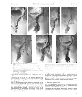 Radiodiagnostic Traitement endovasculaire des varicocèles 34-450-D-10 
*A *B *C *D 
¦ Au cours du cathétérisme 
Deux incidents peuvent se produire assez facilement au cours du 
cathétérisme : 
– L’effraction (fig 18) : il s’agit soit d’une effraction au niveau de la 
veine cave lors de la recherche de la veine testiculaire droite ; il s’agit 
d’une petite injection de produit de contraste au niveau pariétal, 
sans conséquence. 
Mais, ces effractions peuvent être un peu plus importantes si l’on 
s’engage en particulier à gauche dans une petite collatérale. Il faut 
toujours être très prudent lors de l’injection, comme on l’a indiqué 
dans la technique, et vérifier que l’extrémité du cathéter est bien 
dans le tronc veineux principal. L’effraction n’a pas en soi de 
conséquence mais elle peut entraîner un spasme de la veine. Il faut 
donc essayer de dépasser cette zone avec un guide souple afin de 
reprendre le traitement habituel. 
– Un spasme peut se produire sur le guide ou la sonde, ce qui n’a 
en général pas de conséquence, voire au contraire permet un 
meilleur effet du produit sclérosant, injecté en sous-jacent. Il est rare 
que le spasme empêche le cathétérisme soit par la sonde, soit par un 
guide-cathéter (fig 29, 39) Un vasodilatateur (Fonzylanet) injecté par 
la sonde peut aider pour lever ou franchir la zone spasmée. 
¦ Réactions douloureuses 
Il est à noter que quelques patients peuvent avoir une petite douleur 
transitoire d’environ 1 minute lors de l’injection du sclérosant, soit à 
la première, soit à la deuxième injection. 
Des réactions de faible intensité se produisant dans les 2-3 heures 
suivant l’examen sont banales dans les suites de la sclérose 
endovasculaire : 
23 Différents types de varicocèle et de drainage : varicocèles gauches. 
A. Petite varicocèle. 
B. Varicocèle d’assez gros volume avec un drainage veineux le long du cordon 
spermatique vers le système iliaque externe. 
C. Drainage par la veine du gubernaculum testis (1), directement le long du cor-don 
vers le système veineux iliaque externe (2). 
D. Drainage par le système pudendal externe vers le système fémoral. 1 : veine il-iaque 
externe ; 2 : veine pudendale. 
*E *F *G 
E. Drainage prépubien vers le côté opposé (1), le long du canal inguinal, et par le sys-tème 
pudendal externe vers la veine saphène interne et la veine fémorale (2). 
F. Drainage prépubien volumineux vers le côté opposé, pudendal externe et par des vei-nes 
déférentielles (flèche). 
G. Drainage pudendal externe, le long du cordon et vers le plexus de Santorini (1). 
15 
 