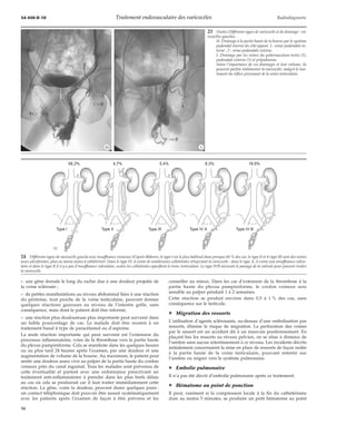 34-450-D-10 Traitement endovasculaire des varicocèles Radiodiagnostic 
*H *I 
58,3% 4,7% 5,4% 8,3% 18,9% 
Type I Type II Type III Type IV A Type IV B 
24 Différents types de varicocèle gauche avec insuffisance veineuse (d’après Bähren), le type I est le plus habituel dans presque 60 %des cas, le type II et le type III sont des veines 
assez plexiformes, plus ou moins aisées à cathétériser. Dans le type IV, il existe de nombreuses collatérales réinjectant la varicocèle : dans le type A, il existe une insuffisance valvu-laire 
et dans le type B il n’y a pas d’insuffisance valvulaire, seules les collatérales opacifient le tronc testiculaire. Le type IVB nécessite le passage de la valvule pour pouvoir traiter 
– une gêne dorsale le long du rachis due à une douleur projetée de 
la veine sclérosée ; 
– de petites manifestations au niveau abdominal liées à une réaction 
du péritoine, tout proche de la veine testiculaire, peuvent donner 
quelques réactions gazeuses au niveau de l’intestin grêle, sans 
conséquence, mais dont le patient doit être informé, 
– une réaction plus douloureuse plus importante peut survenir dans 
un faible pourcentage de cas. Le malade doit être soumis à un 
traitement banal à type de paracétamol ou d’aspirine. 
La seule réaction importante qui peut survenir est l’extension du 
processus inflammatoire, voire de la thrombose vers la partie haute 
du plexus pampiniforme. Cela se manifeste dans les quelques heures 
ou au plus tard 24 heures après l’examen, par une douleur et une 
augmentation de volume de la bourse. Au maximum, le patient peut 
sentir une douleur assez vive au palper de la partie haute du cordon 
veineux près du canal inguinal. Tous les malades sont prévenus de 
cette éventualité et partent avec une ordonnance prescrivant un 
traitement anti-inflammatoire à prendre dans les plus brefs délais 
au cas où cela se produirait car il faut traiter immédiatement cette 
réaction. La gêne, voire la douleur, peuvent durer quelques jours : 
un contact téléphonique doit pouvoir être assuré systématiquement 
avec les patients après l’examen de façon à être prévenu et les 
23 (Suite) Différents types de varicocèle et de drainage : va-ricocèles 
gauches. 
H. Drainage à la partie haute de la bourse par le système 
pudendal interne du côté opposé. 1 : veine pudendale in-terne 
; 2 : veine pudendale externe. 
I. Drainage par les veines du gubernaculum testis (2), 
pudendale externe (1) et prépubienne. 
Selon l’importance de ces drainages et leur volume, ils 
peuvent parfois réalimenter la varicocèle, malgré le trai-tement 
du reflux provenant de la veine testiculaire. 
conseiller au mieux. Dans les cas d’extension de la thrombose à la 
partie haute du plexus pampiniforme, le cordon veineux sera 
sensible au palper pendant 1 à 2 semaines. 
Cette réaction se produit environ dans 0,5 à 1 % des cas, sans 
conséquence sur le testicule. 
¦ Migration des ressorts 
L’utilisation d’agents sclérosants, au-dessus d’une embolisation par 
ressorts, élimine le risque de migration. La perforation des veines 
par le ressort est un accident dû à un mauvais positionnement. En 
plaçant bas les ressorts au niveau pelvien, on se situe à distance de 
l’uretère sans aucun retentissement à ce niveau. Les incidents décrits 
initialement concernaient la mise en place de ressorts de façon isolée 
à la partie haute de la veine testiculaire, pouvant retentir sur 
l’uretère ou migrer vers le système pulmonaire. 
¦ Embolie pulmonaire 
Il n’a pas été décrit d’embolie pulmonaire après ce traitement. 
¦ Hématome au point de ponction 
Il peut, rarement si la compression locale à la fin du cathétérisme 
dure au moins 5 minutes, se produire un petit hématome au point 
la varicocèle. 
16 
 