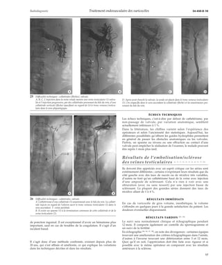 Radiodiagnostic Traitement endovasculaire des varicocèles 34-450-D-10 
*A *B 
de ponction inguinal. Il est exceptionnel d’avoir un hématome plus 
important, sauf en cas de troubles de la coagulation. Il s’agit d’un 
incident banal. 
Il s’agit donc d’une méthode confirmée, existant depuis plus de 
20 ans, qui s’est affinée et améliorée, ce qui explique les variations 
dans les techniques décrites et dans les résultats. 
ÉCHECS TECHNIQUES 
Les échecs techniques, c’est-à-dire par défaut de cathétérisme, par 
non-passage de valvule, par variation anatomique, semblent 
actuellement inférieurs à 1 %. 
Dans la littérature, les chiffres varient selon l’expérience des 
opérateurs et selon l’ancienneté des statistiques. Aujourd’hui, les 
différentes possibilités qu’offrent les guides hydrophiles permettent 
en général de passer les obstacles anatomiques ou les valvules. 
Parfois, un spasme au niveau ou une effraction au contact d’une 
valvule peut empêcher la réalisation de l’examen, le malade pouvant 
être repris 1 mois plus tard. 
Résultats de l’embolisation/sclérose 
des veines testiculaires [4, 10, 13, 30, 32, 35, 42, 48, 56, 72, 80] 
Ils doivent être appréciés avec un esprit critique car les séries sont 
extrêmement différentes ; certains n’exprimant leurs résultats que du 
côté gauche avec des taux de succès ou de récidive très variables, 
d’autres ne font qu’un cathétérisme haut de la veine avec injection 
d’une ampoule de sclérosant. Cela n’a rien à voir avec une 
obturation (avec ou sans ressort) par une injection basse de 
sclérosant. La plupart des grandes séries donnent des taux de 
récidive allant de 1 à 4%. 
RÉSULTATS IMMÉDIATS 
En cas de varicocèle de gros volume, inesthétique, le volume 
s’effondre en quelques jours à la grande satisfaction du patient. Les 
douleurs éventuelles disparaissent. 
RÉSULTATS TARDIFS [75, 79] 
Le suivi sera normalement clinique et échographique pendant 
12 mois. Il comporte également un contrôle du spermogramme et 
un suivi de la fertilité. 
En échographie [90, 96, 97, 98], on note des divergences : certaines équipes 
trouvant une amélioration des critères échographiques dans l’année, 
d’autres à l’inverse trouvant une détérioration entre 3 et 12 mois. 
Quoi qu’il en soit, l’appréciation doit être faite avec rigueur et si 
possible avec le même opérateur en comparant avec les résultats 
antérieurs à la sclérose. 
25 Difficultés techniques : collatérales (flèches), valvule. 
A, B, C. L’injection dans la veine rénale montre une veine testiculaire (1) valvu-lée 
et l’injection progressive, par des collatérales provenant du hile du rein, d’une 
collatérale verticale (flèche) opacifiant en regard de L4 le tronc veineux testicu-laire 
dans le sens physiologique. 
*A *B *C *D 
D. Après avoir franchi la valvule, la sonde est placée dans le tronc veineux testiculaire 
(1). On réopacifie dans le sens ascendant la collatérale (flèche) et les anastomoses pro-venant 
du hile du rein. 
26 Difficultés techniques : collatérales, valvule. 
A. Cathétérisme d’une collatérale (1) anastomosée avec le hile du rein. La collaté-rale 
injecte en regard de l’aileron sacré le tronc veineux testiculaire (2) dans le 
sens ascendant. 3 : veine pariétale. 
B. Il existe un spasme (1) à la terminaison commune de cette collatérale et de la 
veine testiculaire (2). 
17 
 