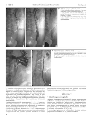 34-450-D-10 Traitement endovasculaire des varicocèles Radiodiagnostic 
*A *B *C 
*A *B 
Le contrôle échographique peut montrer la disparition de la 
distension en particulier sous manoeuvre de Valsalva ou en position 
debout des veines du plexus pampiniforme et la disparition du 
reflux. Lorsque la partie pelvienne basse de la veine testiculaire est 
encore libre, sous la poussée abdominale il peut y avoir un léger 
reflux mais sans distension du plexus pampiniforme. Il faut donc 
apprécier ces éléments avec une équipe pluridisciplinaire, spécialisée 
et entraînée à l’appréciation des résultats du traitement 
endovasculaire. 
Dans les cas d’infertilité, le spermogramme [16, 31, 37, 44, 61, 86] peut être 
réalisé à 3 ou (mieux) à 6 mois. Trois types de modification sont 
décrits : une quasi-normalisation, une amélioration, ou une absence 
d’effet, nettement plus fréquente en cas d’azoospermie. 
Quoi qu’il en soit, les taux de fertilité [16, 23, 31, 37, 41, 61, 86] relevés seraient 
de l’ordre de 35 à 40 % à la suite du traitement, mais cela est difficile 
à apprécier car les patients peuvent bénéficier d’autres 
27 Difficultés techniques : collatérales, valvule. 
A. Veine testiculaire valvulée, cathétérisme d’une colla-térale 
dilatée (2) avec des anastomoses hilaires (1). 
B. Cette collatérale décrit une courbe en double S en re-gard 
de l’aileron sacré et réopacifie le tronc testiculaire (2) 
en dessous. 1 : valvule. 
C. Un guide-cathéter (1) a pu être descendu par la colla-térale 
au pied du S, ce qui a permis la sclérose. Contrôle 
après une ampoule. 
28 Difficultés techniques : collatérales, valvule. 
A. L’injection dans la veine rénale permet la mise en évidence de volu-mineuses 
collatérales provenant du hile du rein et opacifiant le tronc 
veineux testiculaire valvulé à sa terminaison. 
B. Après le passage de la valvule, opacification d’un tronc veineux tes-ticulaire 
unique. 
thérapeutiques associées pour obtenir une grossesse. Pour autant, 
l’indication est portée et la thérapeutique réalisée. 
RÉCIDIVES [68] 
¦ Récidives postchirurgicales 
Après une chirurgie de type Ivanissevich (ligature haute au niveau 
de l’aileron sacré du système veineux testiculaire) [40, 47, 63, 68], les 
récidives sont classiques, de l’ordre de 6 à 9% (dans les meilleures 
mains), dues à la distension des collatérales réopacifiant en dessous 
de la ligature la zone sous-jacente du système veineux testiculaire. 
Cela est très bien vu en phlébographie et parfaitement accessible à 
la technique endovasculaire (fig 40, 41, 42). 
Il peut s’agir également de collatérales à destinée saphène, 
prépubienne, du Santorini ou du gubernaculum testis. 
18 
 