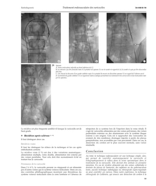 Radiodiagnostic Traitement endovasculaire des varicocèles 34-450-D-10 
*A *B *C 
La récidive est plus fréquente semble-t-il lorsque la varicocèle est de 
haut grade. 
¦ Récidives après sclérose [4, 84] 
Il faut distinguer deux cas. 
Récidives vraies 
Il faut les distinguer les échecs de la technique et les cas après 
embolisation correcte. 
La récidive vraie (1 %) est due à des variations anatomiques : 
alimentation multiple, veine double, alimentation très externe par 
des veines pariétales. Tout cela doit être normalement évité en 
traitant bas la varicocèle. 
Persistance de la varicocèle 
Dans 2 à 4%, la varicocèle persiste ou réapparaît et est alimentée 
par d’autres veines que le système veineux testiculaire. Dans ces cas, 
des contrôles phlébographiques montrent une thrombose du 
système veineux testiculaire dans la zone lombaire et l’absence de 
réinjection de ce système lors de l’injection dans la veine rénale. Il 
s’agit de varicocèles alimentées par des veines pelviennes, des veines 
pudendales externes ou des anastomoses avec le système iliaque 
externe à son origine. Cela est à rapprocher des varicocèles où 
existent de très nombreux drainages injectés à partir du plexus 
pampiniforme, non accessibles par voie percutanée. Dans ces cas, la 
dissection du cordon est le plus souvent normale, sans varice 
résiduelle. 
Conclusion 
Au total, la technique endovasculaire est une technique simple, sûre, 
qui permet de contrôler anatomiquement la varicocèle et 
échographiquement le reflux dans la veine spermatique dans le 
traitement de la varicocèle. Elle devrait être utilisée en première 
intention. En cas de récidive alimentée par des veines collatérales à 
destinée du plexus de Santorini, des saphènes ou du gubernaculum 
testis, aucune technique radiologique ou chirurgicale supra-inguinale 
ne peut contrôler ces varices. Dans notre expérience, la technique 
chirurgicale de Goldstein, qui associe une dissection du cordon à la 
29 Spasme. 
A. Veine testiculaire valvulée au bord inférieur de L2. 
B. La valvule a pu être franchie mais il se produit un spasme (1) sur la sonde en regard de L4, la sonde n’a pas pu être descendue 
plus bas. 
C. On réussit la descente d’un guide-cathéter mais il se produit là encore un deuxième spasme (1) en regard de l’aileron sacré. 
D. Extrémité du guide-cathéter (1) en regard de l’épine sciatique permettant un traitement très correct de la veine testiculaire mal-gré 
les spasmes. 
*D 
19 
 