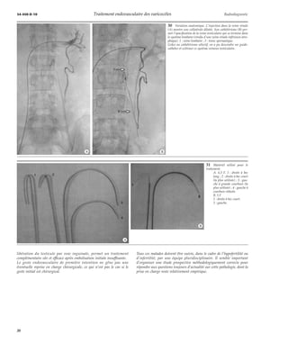 34-450-D-10 Traitement endovasculaire des varicocèles Radiodiagnostic 
*A *B 
libération du testicule par voie inguinale, permet un traitement 
complémentaire sûr et efficace après embolisation initiale insuffisante. 
Le geste endovasculaire de première intention ne gêne pas une 
éventuelle reprise en charge chirurgicale, ce qui n’est pas le cas si le 
geste initial est chirurgical. 
30 Variation anatomique. L’injection dans la veine rénale 
(A) montre une collatérale dilatée. Son cathétérisme (B) per-met 
l’opacification de la veine testiculaire qui se termine dans 
le système lombaire (résidu d’une veine rénale inférieure atro-phique). 
1 : veine lombaire ; 2 : tronc spermatique. 
Grâce au cathétérisme sélectif, on a pu descendre un guide-cathéter 
et scléroser ce système veineux testiculaire. 
31 Matériel utilisé pour le 
traitement. 
A. 6,5 F. 1 : droite à bec 
long ; 2 : droite à bec court 
(la plus utilisée) ; 3 : gau-che 
à grande courbure (la 
plus utilisée) ; 4 : gauche à 
courbure réduite. 
B. 5 F 
1 : droite à bec court. 
2 : gauche. 
Tous ces malades doivent être suivis, dans le cadre de l’hypofertilité ou 
d’infertilité, par une équipe pluridisciplinaire. Il semble important 
d’organiser une étude prospective méthodologiquement correcte pour 
répondre aux questions toujours d’actualité sur cette pathologie, dont la 
prise en charge reste relativement empirique. 
*A 
*B 
20 
 