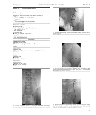 Radiodiagnostic Traitement endovasculaire des varicocèles 34-450-D-10 
Tableau III. – Caractéristiques du matériel. 
Sondes 
Sondes spermatiques 
A. Laboratoire Guerbet 
ç calibre : 6,5 F ; guide 0,35 ; longueur 60 cm ; débit 18 mL/s à 580 PSI 
- droite : 
- petit bec court 3655 (la plus souvent utilisée) 
- bec long 3656 
- gauche : 
- grande courbure 3658 (la plus souvent utilisée) 
- petite courbure 3657 
Cathéter veine spermatique 
B. Laboratoire Cook 
ç calibre : 5 F ; guide 0,38 ; longueur 80 cm ; pas d’orifice latéral 
Débit 13 mL/s à 1 200 PSI 
- Sonde gauche VSC1 
C. Laboratoire Merit 
ç calibre : 5 F ; guide 0,38 ; longueur 65 cm 
- gauche 18 J2 
- Droite petite courbure 1628 J1 
- Droite grande courbure 1628 J3 
Compléments 
Guide de perfusion coaxial 
Laboratoire Cath Net Science 
ç Diamètre interne, 0,24 ; guide 0,35 ; longueur 145 cm 
Âme mobile ; 
1046602 
Cathéter coaxial 
Laboratoire Cook 
ç Calibre : 3 F ; 0,25 diamètre interne ; Admet embole de 0,25 de diamètre 
SKS-3-0-100 
Guides 
Newton : 
Laboratoire Cook 
ç 0,35 ; 150 cm 
Souple : 15 cm en distalité 
TSF NB-35-145 
Guide hydrophile 
Laboratoire Cath Net Science 
ç Higlide ; 150 cm ; 0,035 angle ; 
1049966 
34 Technique de traitement. Après mise en place d’un ressort (2) et injection d’une 
première ampoule de sclérosant, la sonde (1) est en partie retirée de façon à scléroser 
plus haut le système veineux testiculaire. 
32 Technique de traitement. La sonde a été descendue bas en regard de l’épine sciatique. 
Le tronc veineux testiculaire sus-jacent n’est pas visible, suite à un spasme sur la sonde. 
33 Technique de traitement. Position respective de la sonde et des ressorts (flèche) 
après leur largage. 
35 Technique de traitement. Il existait deux branches importantes au niveau pelvien, 
on a d’abord placé dans la première branche cathétérisée un ressort (flèche) ; puis la 
sonde a été descendue bas dans le tronc principal pour la sclérose. 
21 
 