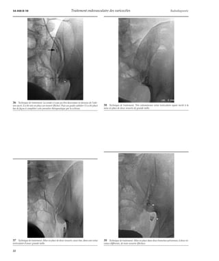 34-450-D-10 Traitement endovasculaire des varicocèles Radiodiagnostic 
36 Technique de traitement. La sonde n’a pas pu être descendue en dessous de l’aile-ron 
sacré, il a été mis en place un ressort (flèche). Puis un guide-cathéter (1) a été placé 
bas de façon à compléter cette première thérapeutique par la sclérose. 
37 Technique de traitement. Mise en place de deux ressorts, assez bas, dans une veine 
testiculaire d’assez grande taille. 
38 Technique de traitement. Très volumineuse veine testiculaire ayant incité à la 
mise en place de deux ressorts de grande taille. 
39 Technique de traitement. Mise en place dans deux branches pelviennes, à deux ni-veaux 
différents, de trois ressorts (flèches). 
22 
 