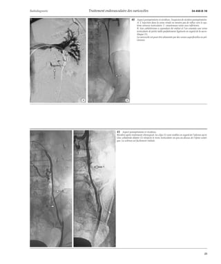 Radiodiagnostic Traitement endovasculaire des varicocèles 34-450-D-10 
40 Aspect postopératoire et récidives. Suspicion de récidive postopératoire. 
A. L’injection dans la veine rénale ne montre pas de reflux vers le sys-tème 
veineux testiculaire. 1 : anastomose veine cave inférieure. 
B. Son cathétérisme a cependant été réalisé et l’on constate une veine 
testiculaire de petite taille parfaitement ligaturée en regard de la sacro-iliaque 
(1). 
La varicocèle est peut-être alimentée par des veines superficielles ou pel-viennes. 
*A *B 
41 Aspect postopératoire et récidives. 
Récidive après traitement chirurgical, les clips (1) sont visibles en regard de l’aileron sacré. 
Une collatérale dilatée (2) réinjecte le tronc testiculaire un peu au-dessus de l’épine sciati-que. 
La sclérose est facilement réalisée. 
23 
 