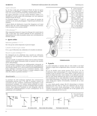34-450-D-10 Traitement endovasculaire des varicocèles Radiodiagnostic 
Agents sclérosants 
Le sel d’un acide gras provenant de l’huile de foie de morue 
(Varicocidt en Allemagne) ; ce produit n’est pas admis aux États- 
Unis, non reconnu par la Food and Drug Administration (FDA). 
Des agents sclérosants [49] de type sodium tétradécyl sulfate à 3 %, 
(Trombovart), le plus utilisé, très économique, avec une expérience 
clinique de plus de 50 ans. 
Les produits chauds [73, 86] (100 °C) : qu’il s’agisse de produit de 
contraste ou de sérum physiologique. L’injection peut entraîner des 
douleurs. 
L’alcool absolu est douloureux et peut être dangereux car il peut 
diffuser dans des veines anastomotiques, entraînant des nécroses. 
Cela est surtout vrai en secteur artériel. 
Colles plastiques [51] 
Elles comportent toujours le risque d’un blocage de la sonde dans la 
colle ; il faut donc une certaine habitude de leur maniement. La 
reperméation de la colle est possible comme cela a été démontré en 
territoire artériel. 
¦ Agents solides 
Ballonnets gonflables [47, 81, 93, 95] 
Ils n’ont qu’une action temporaire et peuvent migrer. 
Cylindres d’Ivalon de gros volume 
Il n’y a pas d’obturation des collatérales et le résultat est aléatoire. 
Ressorts ou spires métalliques [64, 94] 
Ils n’atteignent pas les collatérales mais, associés aux sclérosants, 
permettent une excellente obturation du système veineux 
testiculaire. 
À l’heure actuelle, la majorité des auteurs, tout au moins en Europe, 
utilisent soit les agents sclérosants isolés ou associés à des ressorts, 
soit la colle plastique. 
Cette technique d’obturation par phlébographie rétrograde ne 
nécessite qu’une anesthésie locale, n’entraîne pas d’hospitalisation, 
sans incision cutanée. Il n’y a pas d’arrêt de travail (habituellement). 
Cette méthode n’entraîne qu’une irradiation minime, voire 
négligeable. Elle est la moins invasive, la moins coûteuse et doit 
donc être utilisée en première intention [1, 22, 43, 50]. 
Anatomie [3, 6, 9, 12, 14, 17, 19, 38, 53, 54, 74] 
La pratique de cette technique implique des connaissances 
anatomiques précises (fig 2). En effet, le système veineux est 
caractérisé par des variations extrêmement importantes et des 
anastomoses multiples. Un schéma mental préétabli est donc 
nécessaire de façon à naviguer au mieux et aisément dans le système 
veineux. Nous décrivons l’anatomie en sens rétrograde, selon les 
constatations phlébographiques et leurs conséquences sur le 
cathétérisme et le traitement. 
TERMINAISON 
¦ À gauche 
La veine testiculaire se termine dans la veine rénale à son bord 
inférieur, à angle droit ou légèrement obtus, à environ 1 cm du rachis 
(fig 2). 
En cas de double veine rénale gauche (fig 3, 4A, B, 5A, B) 
(l’inférieure étant rétroaortique), la veine testiculaire peut se 
terminer avant la division de la veine rénale, le plus souvent au 
niveau du départ des deux veines rénales, ou au-delà plus souvent 
dans la veine rénale inférieure que dans la veine rénale supérieure. 
Si la terminaison de la veine testiculaire n’est pas trouvée dans la 
veine rénale préaortique, il faut faire une injection globale dans la 
veine rénale pour repérer d’éventuelles variations de la veine 
testiculaire [88]. 
La veine rénale gauche unique (fig 6A) rétroaortique se termine 
nettement plus bas dans la veine cave inférieure que le niveau 
habituel de la veine rénale préaortique. Il faut connaître cette 
variation anatomique pour la rechercher sur la face gauche de la 
veine cave inférieure en L2-L3 ou L4. 
3 Veine testiculaire gau-che 
: variations anatomi-ques. 
VCI : veine cave infé-rieure. 
1 
2 
3 
4 
5 
6 
7 
8 
9 
10 
11 
12 
13 
14 
15 
2 Schéma anatomique. 
1. Veine cave inférieure ; 2. 
Veine rénale gauche ; 3. 
Rein ; 4. Veine testiculaire 
gauche ; 5. Veine iliaque ex-terne 
; 6. Veine iliaque in-terne 
; 7. Veine épigastrique 
inférieure profonde ; 8. 
Veine épigastrique superfi-cielle 
; 9. Veine crémasté-rienne 
; 10. Canal inguinal ; 
11. Veine pudendale ex-terne 
; 12. Veine déféren-tielle 
; 13. Veine saphène in-terne 
; 14. Veine fémorale ; 
15. Plexus pampiniforme 
4 
 
