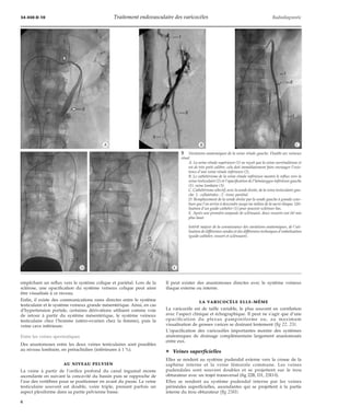 34-450-D-10 Traitement endovasculaire des varicocèles Radiodiagnostic 
*A *B *C 
*D *E 
empêchant un reflux vers le système colique et pariétal. Lors de la 
sclérose, une opacification du système veineux colique peut ainsi 
être visualisée à ce niveau. 
Enfin, il existe des communications rares directes entre le système 
testiculaire et le système veineux grande mésentérique. Ainsi, en cas 
d’hypertension portale, certaines dérivations utilisent comme voie 
de retour à partir du système mésentérique, le système veineux 
testiculaire chez l’homme (utéro-ovarien chez la femme), puis la 
veine cave inférieure. 
Entre les veines spermatiques 
Des anastomoses entre les deux veines testiculaires sont possibles 
au niveau lombaire, en prérachidien (inférieures à 1 %). 
AU NIVEAU PELVIEN 
La veine à partir de l’orifice profond du canal inguinal monte 
ascendante en suivant la concavité du bassin puis se rapproche de 
l’axe des vertèbres pour se positionner en avant du psoas. La veine 
testiculaire souvent est double, voire triple, prenant parfois un 
aspect plexiforme dans sa partie pelvienne basse. 
5 Variations anatomiques de la veine rénale gauche. Double arc veineux 
rénal. 
A. La veine rénale supérieure (1) ne reçoit que la veine surrénalienne et 
est de très petit calibre, cela doit immédiatement faire envisager l’exis-tence 
d’une veine rénale inférieure (2). 
B. Le cathétérisme de la veine rénale inférieure montre le reflux vers la 
veine testiculaire (2) et l’opacification de l’hémiazygos inférieure gauche 
(1). veine lombaire (3). 
C. Cathétérisme sélectif, avec la sonde droite, de la veine testiculaire gau-che. 
1 : collatérales ; 2 : tronc pariétal. 
D. Remplacement de la sonde droite par la sonde gauche à grande cour-bure 
que l’on arrive à descendre jusqu’au milieu de la sacro-iliaque. Uti-lisation 
d’un guide-cathéter (1) pour pouvoir scléroser bas. 
E. Après une première ampoule de sclérosant, deux ressorts ont été mis 
plus haut. 
Intérêt majeur de la connaissance des variations anatomiques, de l’uti-lisation 
de différentes sondes et des différentes techniques d’embolisation 
(guide-cathéter, ressort et sclérosant). 
Il peut exister des anastomoses directes avec le système veineux 
iliaque externe ou interne. 
LA VARICOCÈLE ELLE-MÊME 
La varicocèle est de taille variable, le plus souvent en corrélation 
avec l’aspect clinique et échographique. Il peut ne s’agir que d’une 
opacification du plexus pampiniforme ou, au maximum 
visualisation de grosses varices se drainant lentement (fig 22, 23). 
L’opacification des varicocèles importantes montre des systèmes 
anatomiques de drainage complémentaire largement anastomosés 
entre eux. 
¦ Veines superficielles 
Elles se rendent au système pudendal externe vers la crosse de la 
saphène interne et la veine fémorale commune. Les veines 
pudendales sont souvent doubles et se projettent sur le trou 
obturateur avec un trajet transversal (fig 22B, D1, 23D-I). 
Elles se rendent au système pudendal interne par les veines 
périnéales superficielles, ascendantes qui se projettent à la partie 
interne du trou obturateur (fig 23H). 
6 
 