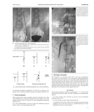 Radiodiagnostic Traitement endovasculaire des varicocèles 34-450-D-10 
*A *B 
Le drainage prépubien superficiel à la base de la verge ou sus-pubien 
vers le système pudendal opposé est fréquent (fig 23E, F, I). 
¦ Veines profondes 
Elles comprennent, outre le système veineux testiculaire, les veines 
crémastériques qui se jettent directement dans l’origine de la veine 
iliaque externe ou par la crosse de la veine épigastrique inférieure 
(fig 23 B, C, I). 
Les veines déférentielles suivent le trajet des déférents jusqu’au 
plexus veineux vésicoprostatique (fig 23F). 
¦ Drainage transeptal 
Peu fréquent, il se voit dans moins de 1 % des cas, normalement 
non connu des anatomistes. Les constatations phlébographiques 
montrent qu’il peut s’agir soit de varicocèle gauche alimentant une 
varicocèle droite sans incontinence de la veine testiculaire droite. Le 
même phénomène peut exister dans l’autre sens (fig 22C). Les 
anastomoses peuvent fonctionner dans les deux sens : chez un même 
patient, l’opacification de chaque côté montre en outre l’opacification 
partielle de la varicocèle du côté opposé (fig 22D). 
AU TOTAL 
Il faut retenir plusieurs variations anatomiques [5, 53, 83, 85] de la veine 
testiculaire qui peuvent plus ou moins compliquer la thérapeutique 
(fig 24). 
– La veine unique non valvulée ne posant aucun problème 
technique (fig 16, 17). 
– La veine double où deux types existent (fig 18) : 
– le premier où les deux veines sont avalvulées ne posant pas de 
problème sauf si les deux troncs ne s’anastomosent pas. Il faut 
cathétériser les deux et les scléroser ; 
6 Variations anatomiques de la veine rénale gauche. 
A. Veine rénale rétroaortique (1) avec cathétérisme testiculaire par la sonde droite. 
(2) tronc veineux ; collatérale (3). 
B. Changement de sonde pour descendre bas, mettre en place des ressorts (flèche) 
puis injecter du sclérosant (contrôle B). 
7 Veine testiculaire droite : variations anatomiques. VCI : veine cave inférieure. 
8 Valvule de la veine tes-ticulaire 
droite. Valvule (1) 
tout près de la terminaison 
de la veine testiculaire dans 
la veine cave inférieure, en 
regard du pédicule de L2 
(2), aspect le plus fréquent. 
9 Valvule de la veine tes-ticulaire 
droite. Valvule à 
3 cm de la terminaison de la 
veine testiculaire, aspect ty-pique. 
Dans ce cas il n’y a 
pas de varicocèle alimentée 
par reflux veineux testicu-laire. 
7 
 