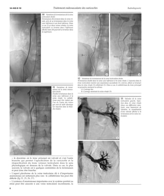 34-450-D-10 Traitement endovasculaire des varicocèles Radiodiagnostic 
11 Variations de termi-naison 
de la veine testicu-laire 
droite. 
Double terminaison dans la 
veine cave inférieure et la 
veine rénale. Le cathété-risme 
peut être réalisé par 
l’un ou l’autre des troncs 
qui sont de taille identique 
(ici injection dans la bran-che 
rénale). 
– le deuxième où le tronc principal est valvulé et c’est l’autre 
branche qui permet l’opacification de la varicocèle et la 
réopacification du tronc veineux testiculaire dans le sens 
physiologique en dessous de la valvule. Dans ce cas, le plus 
souvent, la valvule est à quelques centimètres de la terminaison 
et peut donc être franchie. 
– L’aspect plexiforme de la veine testiculaire dû à d’importantes 
anastomoses est nettement plus rare : le cathétérisme bas peut être 
difficile (fig 21, 25, 26, 27). 
– L’existence d’anastomoses importantes avec le système pariétal ou 
rénal peut être associée à une veine testiculaire incontinente, la 
*A *B 
12 Variations de terminaison de la veine testiculaire droite. 
Terminaison double dans la veine cave inférieure et la veine rénale. L’injection dans le 
tronc testiculaire montre une anastomose ascendante (1), externe, allant se terminer 
dans la veine rénale (3) collatérale (2). Dans ce cas, le cathétérisme du tronc principal 
va permettre aisément la sclérose. 
A. Centrage bas. 
B. Centrage montrant la veine rénale (3). 
13 Valvules de la veine 
testiculaire gauche. Injec-tion 
dans la veine rénale 
(deux cas différents) mon-trant, 
sous manoeuvre de 
Valsalva, la visualisation 
d’une valvule (flèche) à la 
terminaison de la veine tes-ticulaire. 
*A 
*B 
10 Variations de terminaison de la veine 
testiculaire droite. 
Terminaison directement dans la veine ré-nale, 
près de sa terminaison dans la veine 
cave inférieure à son bord inférieur. Dans 
ce cas, il y a deux veines rénales, la veine 
testiculaire se termine dans l’inférieure 
(flèche) mais elle pourrait se terminer dans 
la supérieure. 
8 
 