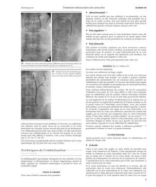 Radiodiagnostic Traitement endovasculaire des varicocèles 34-450-D-10 
*A *B 
sclérose basse ne posant aucun problème. À l’inverse, ces collatérales 
très dilatées sont la seule cause de la varicocèle et la veine 
testiculaire est valvulée, le plus souvent très près de sa terminaison. 
Ces collatérales peuvent être une cause d’échec car elles sont le plus 
souvent non cathétérisables et la valvule très proche de la veine 
rénale peut être difficile à franchir, voire cause d’échec technique 
(fig 21, 25, 26, 27, 28, 29). 
Une terminaison exceptionnelle dans le système lombaire de la veine 
spermatique (fig 30) peut être une cause d’échec. 
Techniques de l’embolisation [10, 13, 31, 32, 35, 42, 48, 
51, 53, 56, 71, 72, 80, 83, 94] 
La phlébographie spermatique rétrograde est une méthode à la fois 
diagnostique et thérapeutique. Le temps diagnostique permet le 
bilan, apprécie les variations anatomiques et permet le choix du 
traitement adapté. 
VOIES D’ABORD 
Trois voies d’abord veineuses sont possibles. 
¦ Abord brachial [70] 
Cela ne nous semble pas une méthode à recommander car des 
spasmes veineux ou des réactions veineuses sont possibles sur le 
trajet de la sonde au bras. Son seul intérêt est une plus grande 
facilité pour pénétrer bas dans le territoire testiculaire droit mais le 
cathétérisme gauche n’est pas toujours aisé par cette voie. 
¦ Voie jugulaire [30] 
Elle est très aisée (surtout pour la veine testiculaire droite), mais elle 
semble un peu agressive pour le patient et ne mérite guère d’être 
utilisée sauf dans des cas très particuliers de variation du système cave. 
¦ Voie fémorale 
Elle permet d’accéder aisément aux deux territoires veineux 
testiculaires, elle est très facile à réaliser, ne présente pas de risque 
particulier pour le patient. Il s’agit habituellement de la voie 
fémorale droite car la majorité des opérateurs sont droitiers. Les 
courbures de sonde sont adaptées à cette voie. 
Nous n’utilisons pour notre part quasiment que cette voie. 
SONDES (fig 31) (tableau III) 
Les sondes ont des impératifs. 
La veine cave inférieure est large, souple. 
Les veines rénales sont d’un bon calibre et de ce fait, il ne faut pas 
prendre des sondes trop souples : les sondes à grande courbure 
permettent des adossements sur ces vaisseaux pour autoriser un 
cathétérisme le plus bas possible. À l’inverse, des sondes trop rigides 
ou à courbure non adaptée ne permettent pas de descendre bas dans 
le système veineux testiculaire gauche. 
Nous utilisons habituellement des sondes 160 (6,5 F), permettant 
l’utilisation d’un guide de 0,35, mais effilées à 0,38 à leur extrémité, 
pour un cathétérisme aisé du système veineux testiculaire (Guerbet 
Médical). Des sondes de 5 F ou de 4 F plus fines peuvent être utilisées. 
Le seul impératif est de réaliser l’embolisation et la sclérose bas au 
niveau pelvien, en regard de la projection de l’épine sciatique ou de 
la partie basse de l’interligne sacro-iliaque. Avec des sondes 
précourbées, ce niveau peut aisément être atteint à gauche. À droite, 
en revanche, l’angulation très aiguë de la veine testiculaire, à sa 
terminaison dans la veine cave inférieure, nécessite des sondes très 
anglées qui ne peuvent pas progresser dans la veine testiculaire 
droite. Il faut donc utiliser un guide-cathétert ou un coaxial [7, 8, 60] 
que l’on va faire progresser dans la veine testiculaire, pour que son 
extrémité atteigne le même niveau qu’à gauche. Ils peuvent être 
aussi utilisés à gauche en cas de difficultés de cathétérisme. 
D’autres auteurs utilisent des sondes à ballonnet gonflable [7, 74] 
permettant d’obturer la veine à sa partie terminale. 
CATHÉTÉRISME 
Après ponction de la veine fémorale droite, le cathétérisme est 
réalisé de chaque côté. 
¦ À droite 
Grâce à une sonde très anglée, la veine rénale est opacifiée sous 
scopie, sous manoeuvre de Valsalva. Cette opacification permet de 
mettre en évidence la veine testiculaire dans 10 % des cas. Il faut 
que la sonde soit à l’entrée de la veine rénale, de façon à bien 
profiter de l’abaissement du rein lors de la manoeuvre de Valsalva. 
L’opacification de la veine testiculaire peut n’être que transitoire, à 
saisir si besoin par un cliché. 
Si la veine testiculaire n’a pas été décelée à ce niveau, elle est 
recherchée dans la veine cave inférieure. Habituellement, elle 
s’abouche sur la face antérodroite de la veine cave inférieure aux 
alentours de L2. Mais elle peut s’aboucher plus haut, à partir de L1, 
et plus bas jusqu’à L4. Une injection dans la veine cave en scopie 
14 Valvules de la veine testiculaire gauche. Différents aspects de valvules (flèches) de 
la veine testiculaire au niveau lombaire, proches de sa terminaison (A, B). 
15 Valvules de la veine testiculaire gau-che. 
Il existe ici deux valvules (flèches) 
successives sans aucun reflux sous-jacent. 
9 
 