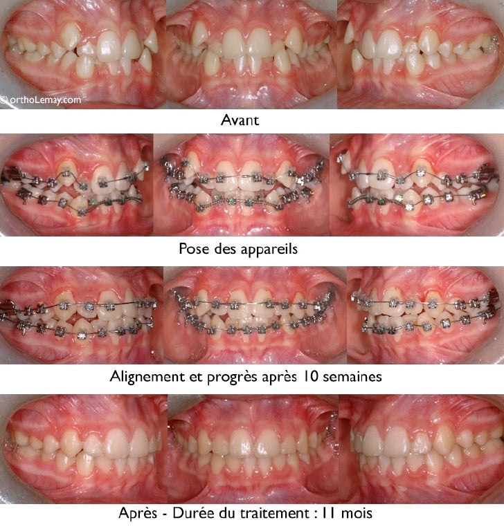 Traitement orthodontie sherbrooke lemay