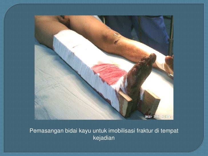 Traksi Dalam Orthopaedi Dr Yuda Umm Traksi Dalam Orthopaedi Dr Yuda Umm