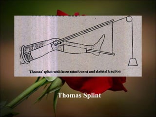 Thomas Splint 