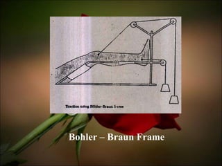 Bohler – Braun Frame 