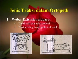 Jenis Traksi dalam Ortopedi Weber Extensionsapparat Traksi kulit dan traksi skeletal Fraktur batang femur pada anak-anak 