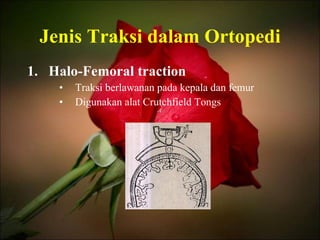 Jenis Traksi dalam Ortopedi Halo-Femoral traction Traksi berlawanan pada kepala dan femur Digunakan alat Crutchfield Tongs 