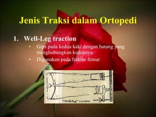 Jenis Traksi dalam Ortopedi Well-Leg traction Gips pada kedua kaki dengan batang yang menghubungkan keduanya. Digunakan pada fraktur femur 