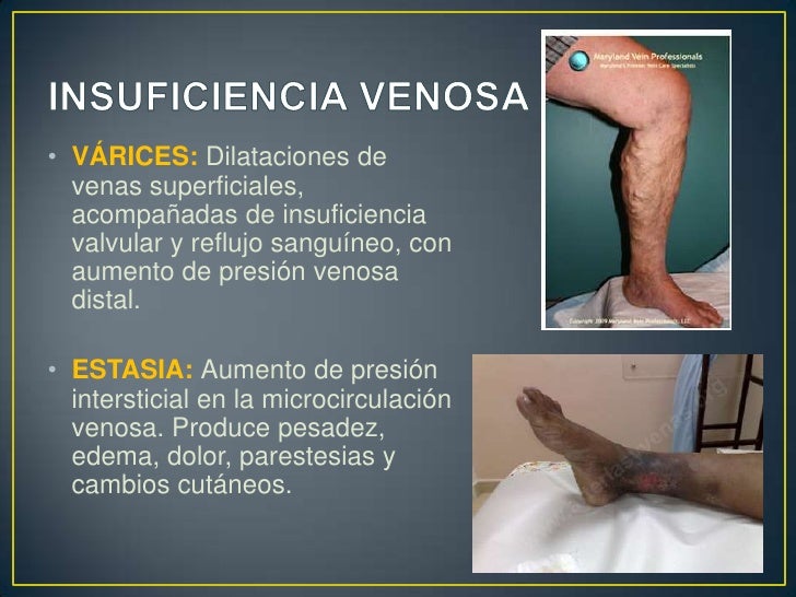 Tramiento médico de la insuficiencia venosa