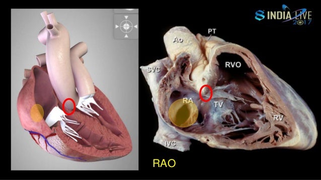 9.3.6 to how jailbreak puncture Trans septal 9.3.6 to how jailbreak puncture Trans septal