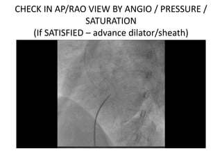 CHECK IN AP/RAO VIEW BY ANGIO / PRESSURE /
SATURATION
(If SATISFIED – advance dilator/sheath)
 