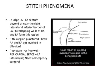 STITCH PHENOMENA
• In large LA - no septum
beyond or near the right
lateral and inferior border of
LA - Overlapping walls of RA
and LA form this region
• If this region punctured - both
RA and LA get involved in
effusion!
• (Puncture- RA free wall -
PERICARDIAL SPACE – LA
lateral wall) Needs emergency
surgery!
 